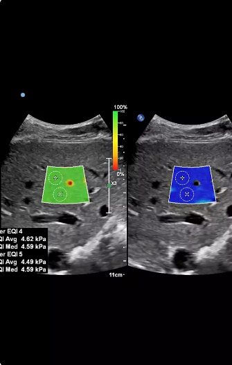 Shearwave Liver Elastography/ Fibroscan